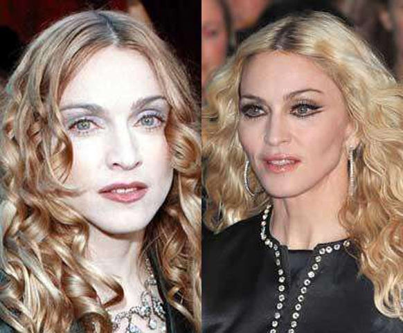 Burun Estetiği Yaptıran Ünlüler Madonna